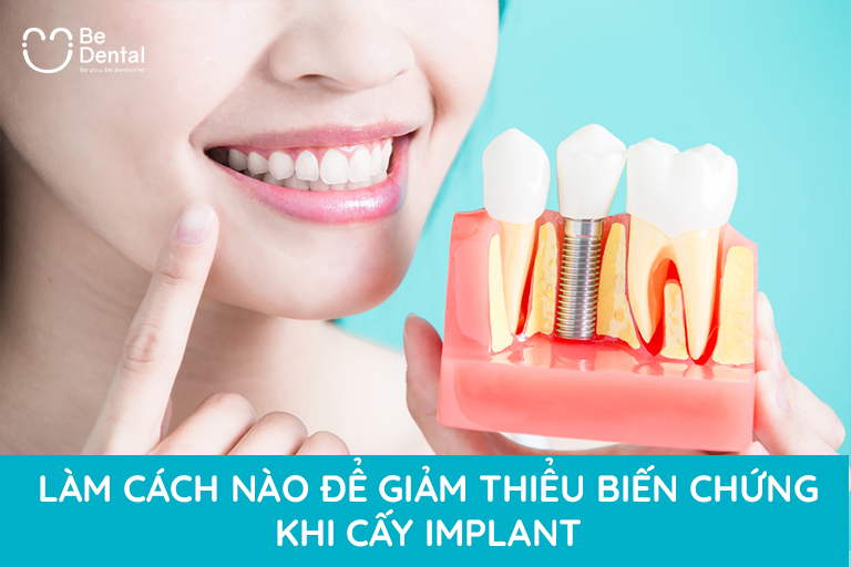 Giảm thiếu biến chứng khi trồng răng implant