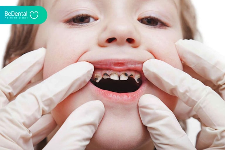 Điều trị răng sâu trẻ em bằng kỹ thuật hàn răng ART mang lại hiệu quả cao, giúp trẻ em còn ám ảnh khi tới nha sĩ điều trị