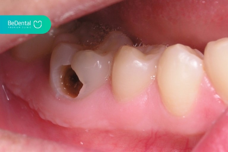 Với lỗ sâu trên răng được hình thành và có thể xoang trám thuận lợi thì kỹ thuật trám răng không sang chấn ART có thể thực hiện
