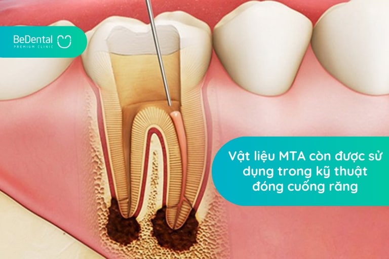 Hàn răng MTA mang lại độ kín khít nên được ứng dụng trong đóng cuống răng phức tạp