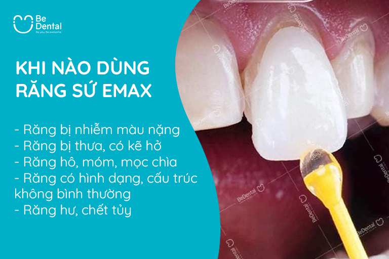 Khi nào nên làm răng sứ emax