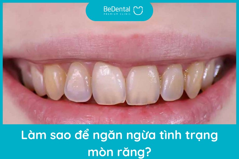 Trám răng bị mòn và Làm sao để ngăn ngừa tình trạng mòn men răng