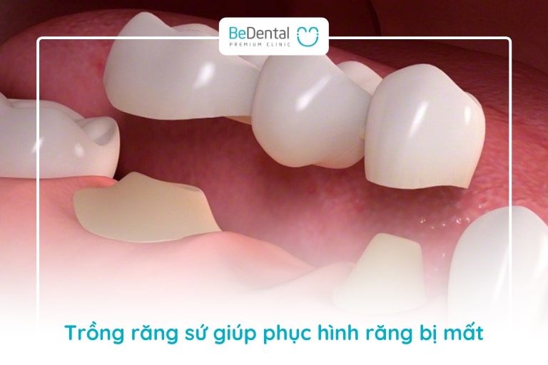 Trồng răng sứ phù hợp áp dụng với trường hợp mất ít răng