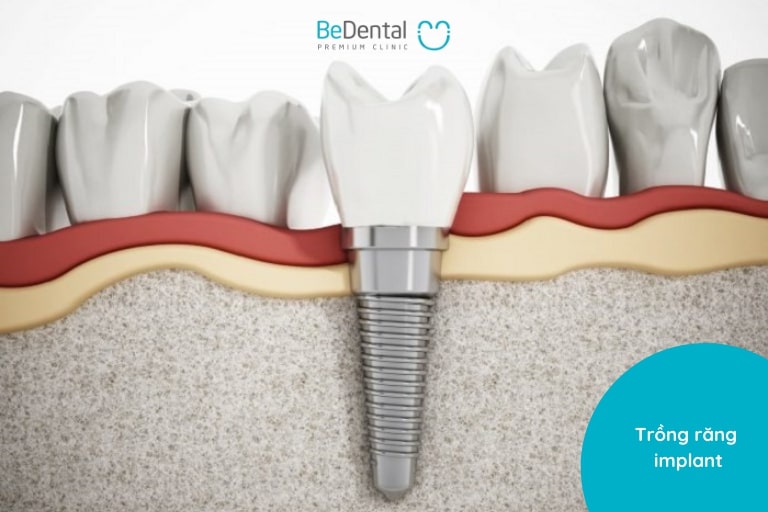 Trồng răng implant chỉ định cho cả trường hợp mất ít hoặc nhiều răng