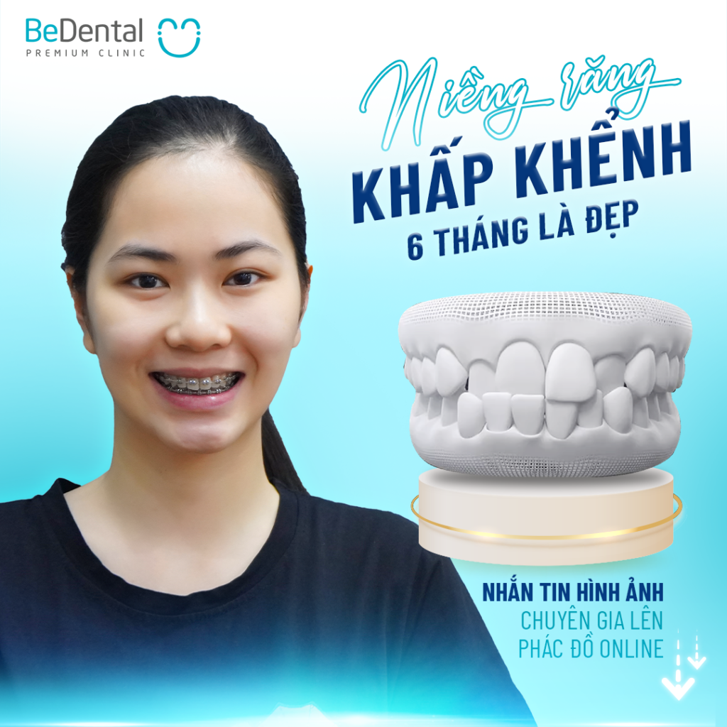 bọc răng sứ có niềng được không