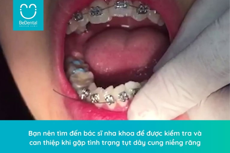 Tụt dây cung khi niềng răng cần được can thiệp bởi bác sĩ chuyên khoa