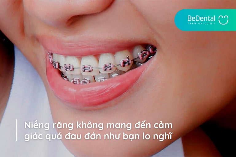 Niềng răng không gây ra nhiều cảm giác đau đớn khiến bạn khó chịu