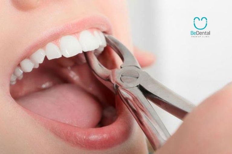 Trong một vài trường hợp cần nhổ răng để thuận lợi khi niềng