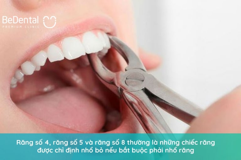 Những chiếc răng nào có thể nhổ khi niềng răng buộc phải nhổ bỏ?