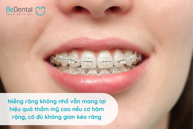 Niềng răng không nhổ răng vẫn đem lại tính thẩm mỹ cao