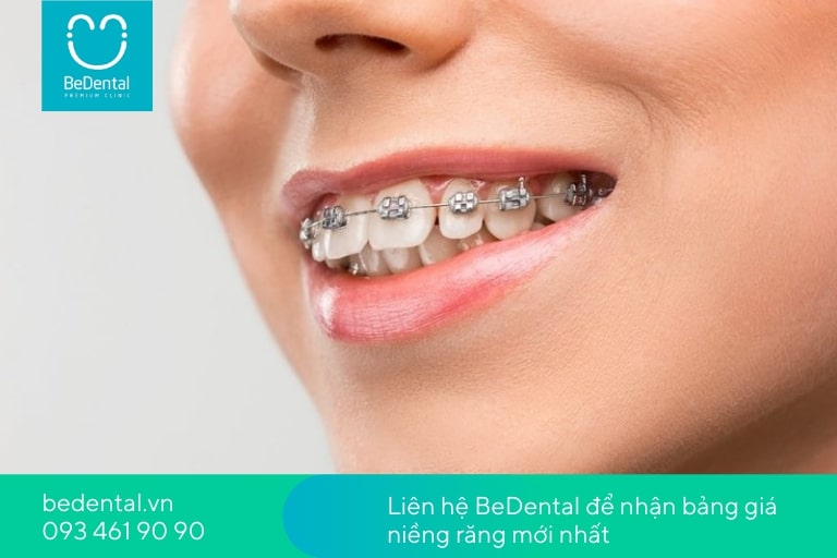 BeDental là địa chỉ uy tín để niềng răng an toàn, tư vấn rõ ràng có nên nhổ răng hay không chuẩn nhất