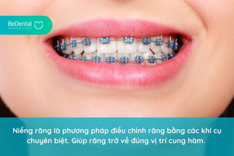 Các loại niềng răng là gì?