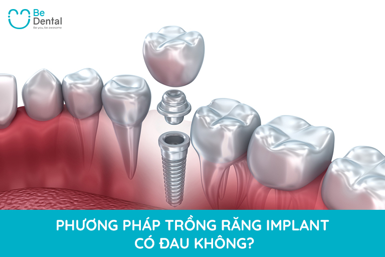 Phương pháp trồng răng implant có đau không?