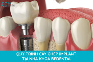 Quy trình trồng răng implant tại nha khoa Bedental