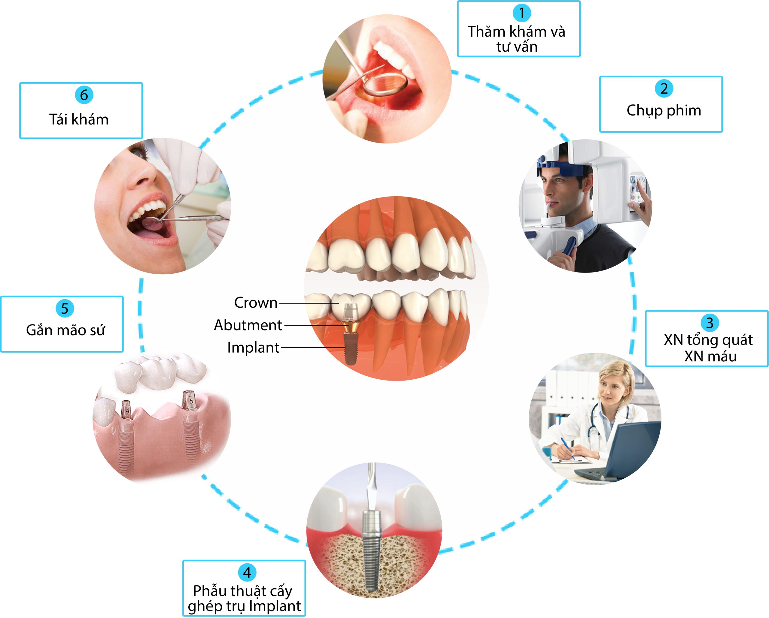 trồng răng implant ở đâu tốt tphcm