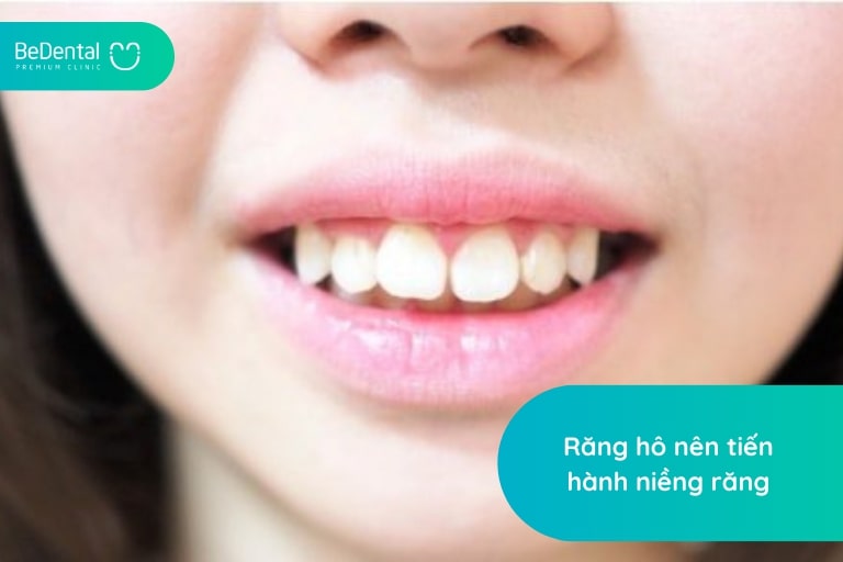 Niềng răng bị hô vẩu là phương pháp thẩm mỹ răng hiệu quả, được nha sĩ khuyến khích tiến hành
