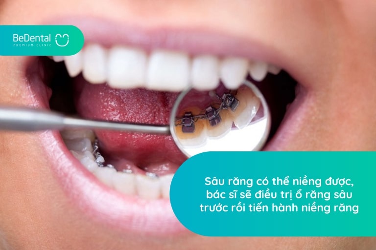 Răng sâu vẫn có thể tiến hành niềng răng an toàn nếu được thực hiện bởi bác sĩ giỏi