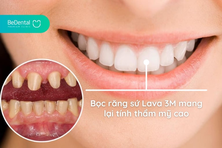 Bọc răng sứ Lava 3M giúp khắc phục khuyết điểm hoàn hảo trên răng và làm răng sáng đẹp tự nhiên