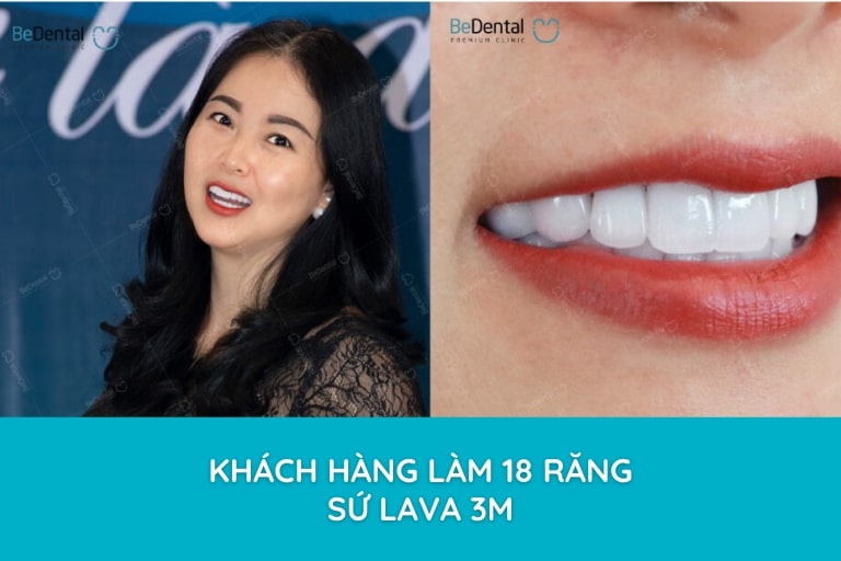 Tuổi thọ và độ bền đẹp của răng sứ Lava được đánh giá cực kỳ cao