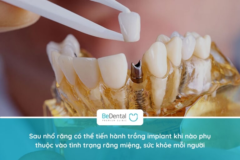 Sau khi nhổ răng bao lâu thì trồng implant?
