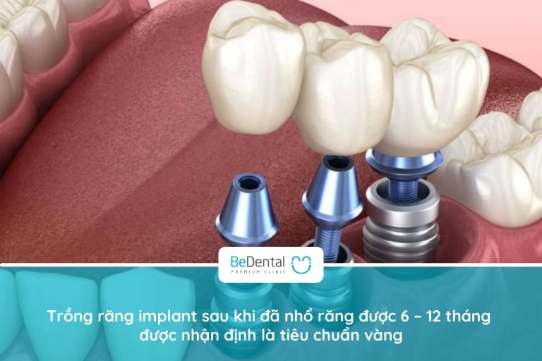 Trồng răng implant khi đã nhổ 6 - 12 tháng sẽ ít bị rủi ro xảy ra