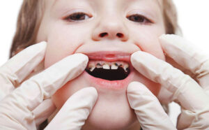sâu răng; sâu răng ở trẻ; dự phòng sâu răng; dự phòng sâu răng ở trẻ; 