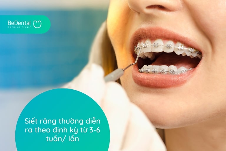 Siết răng khi niềng răng là gì?Siết răng định kỳ khi niềng răng bao lâu một lần?