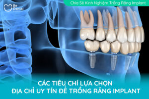 tiêu chí lựa chọn trồng răng implant uy tín