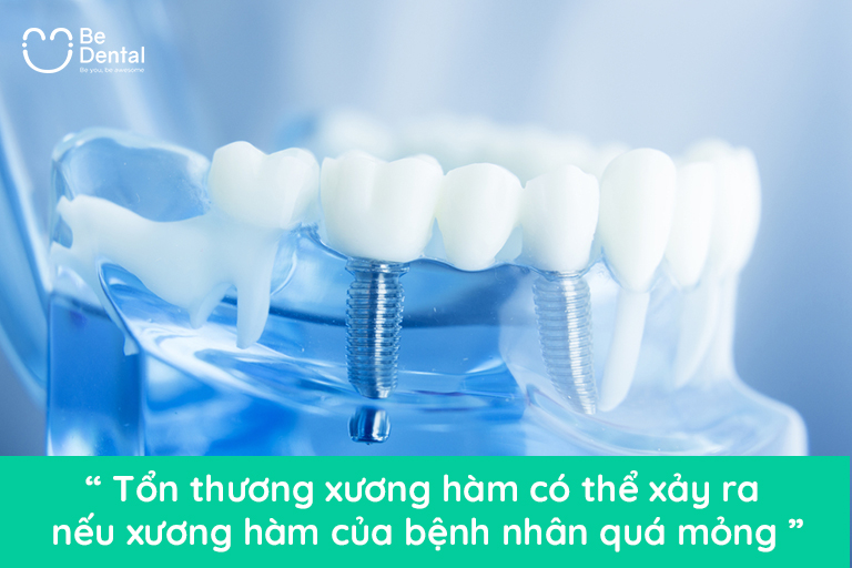 Tổn thương xương hàm khi trồng răng implant
