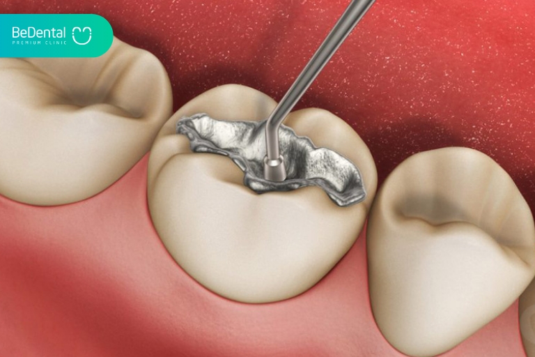 Amalgam là vật liệu trám răng được sử dụng rộng rãi nhiều năm về trước