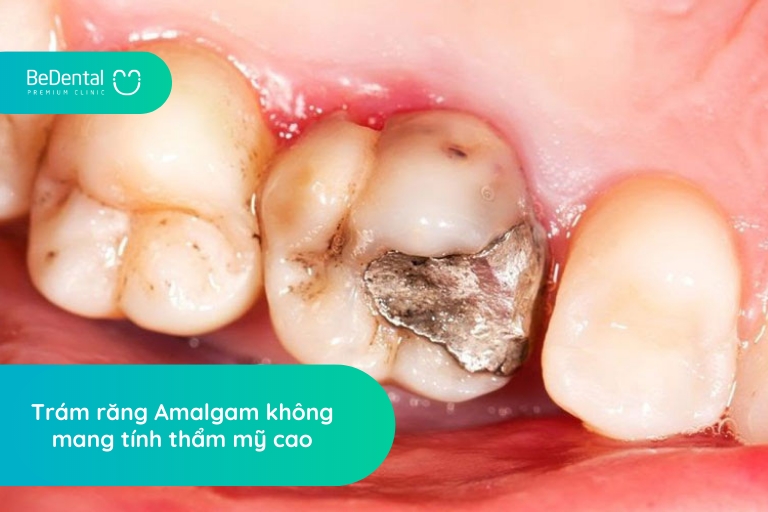 Hàn răng Amalgam không đảm bảo tính thẩm mỹ cao
