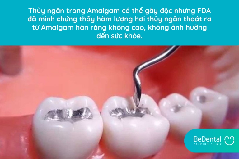 Hàn răng Amalgam có độc không?