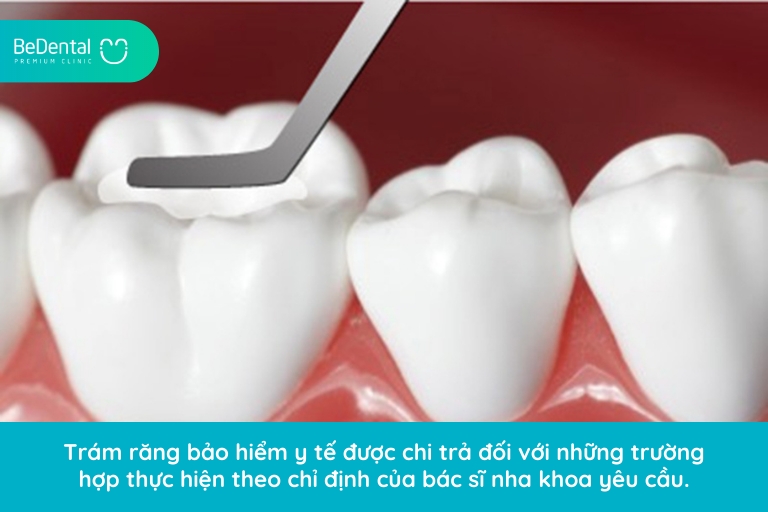Trám răng bảo hiểm y tế vẫn chi trả đủ quyền lợi nếu như bạn được bác sĩ yêu cầu thực hiện hàn trám