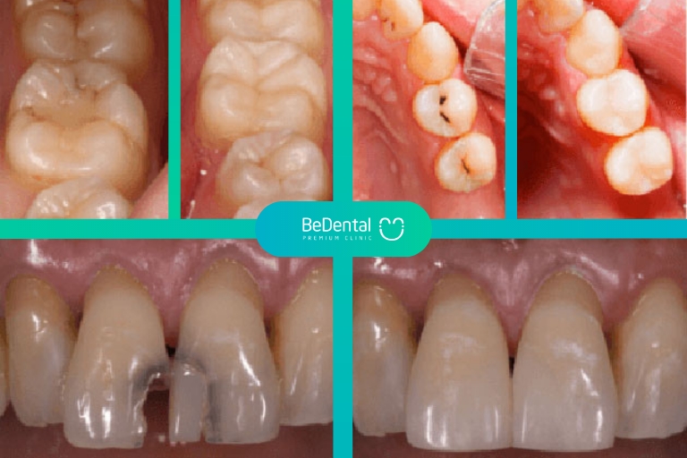 Trám răng bảo hiểm y tế vẫn đảm bảo chất lượng cùng độ an toàn sức khỏe