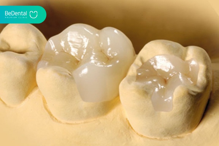 Trám răng Inlay Onlay phù hợp với hầu hết các trường hợp khuyết điểm trên răng cần phục hình thẩm mỹ