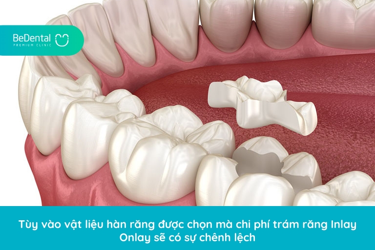 Chi phí trám răng Inlay Onlay sẽ có sự chênh lệch phụ thuộc vào vật liệu hàn răng