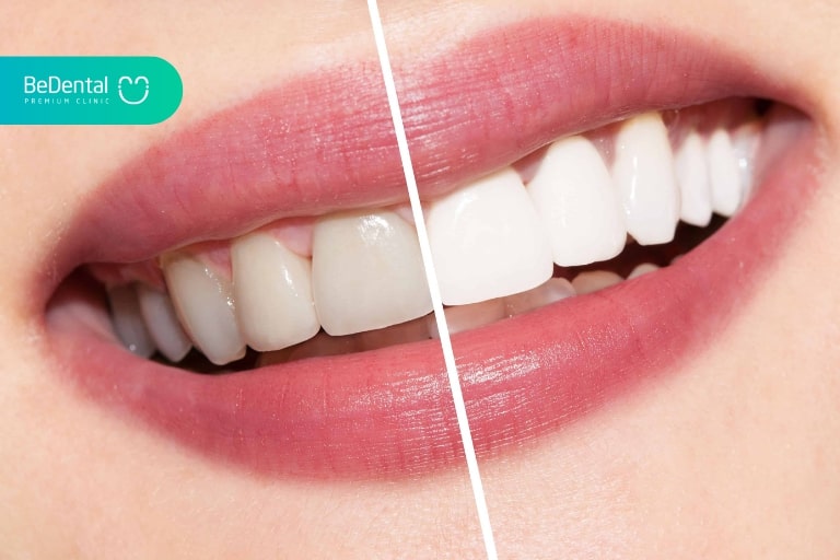 dental fillings and teeth whitening