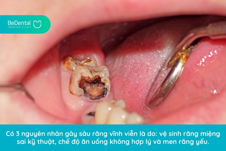 Có rất nhiều nguyên nhân gây ra tình trạng răng vĩnh viễn bị sâu