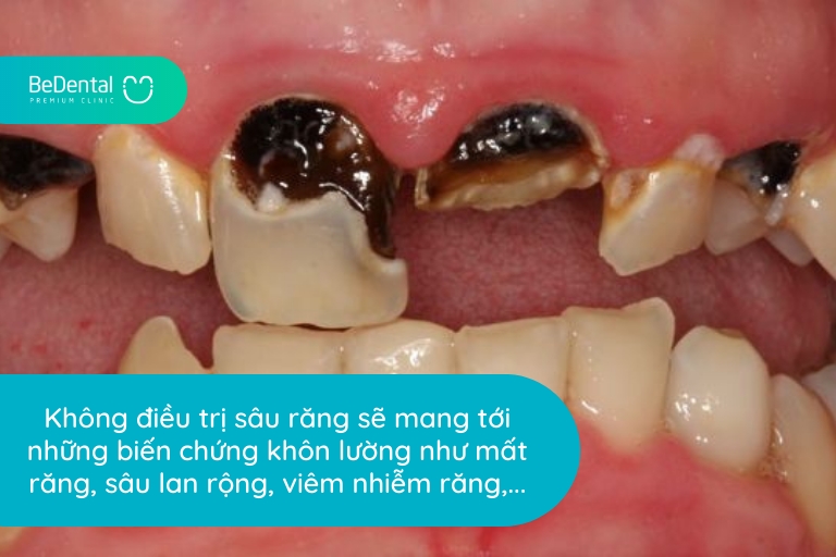 Không tiến hành điều trị răng vĩnh viễn bị sâu sẽ có thể làm mất răng vĩnh viễn, ảnh hưởng cực kỳ xấu đến thẩm mỹ,...