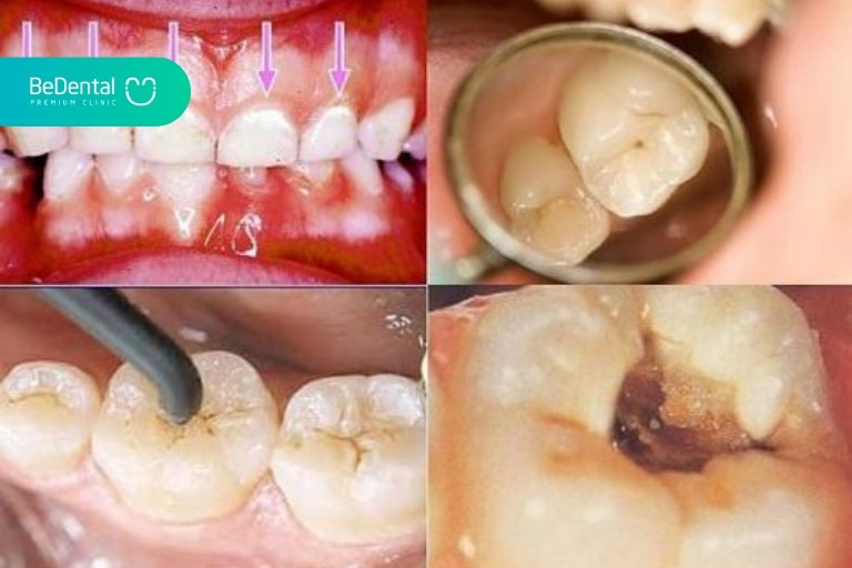 Hàn răng xong vẫn đau nhức có thể là do bị viêm nhiễm trước đó nhưng không được điều trị đã thực hiện trám răng