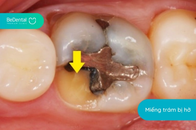 Miếng trám bị hở cũng là nguyên nhân khiến tình trạng đau nhức sau trám răng xuất hiện