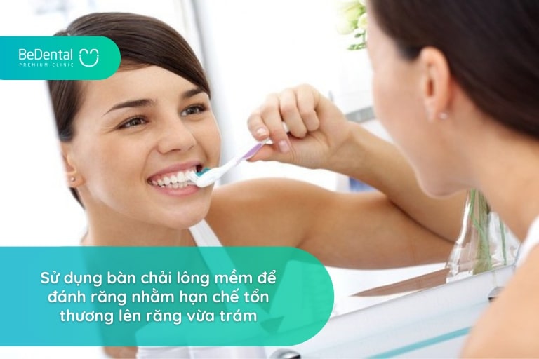 Sau khi trám răng, bạn nên sử dụng bàn chải lông mềm để vệ sinh răng miệng