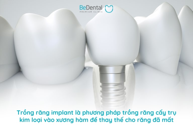 Trồng răng implant là gì?