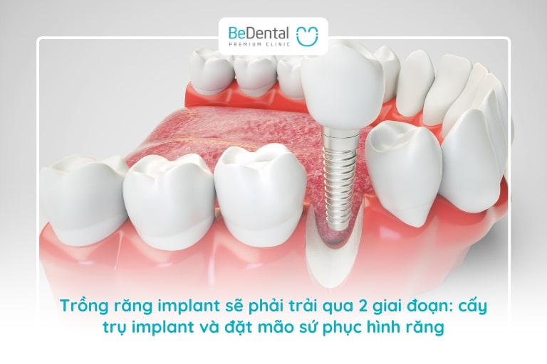 Trồng răng implant sẽ phải trải qua 2 giai đoạn với thời gian chờ khác nhau