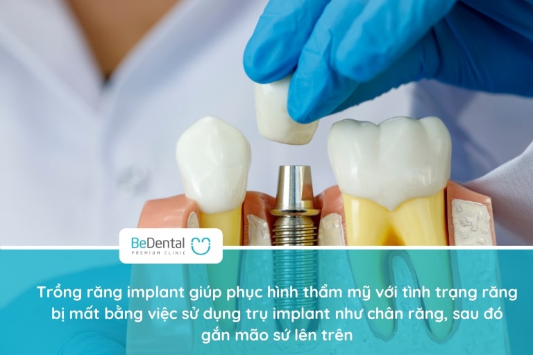 Trồng răng implant giúp phục hình thẩm mỹ hoàn hảo với những trường hợp mất răng