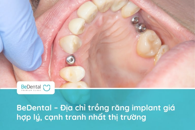 Trồng răng implant hưởng nhiều ưu đãi giảm giá, cam kết chất lượng tại BeDental