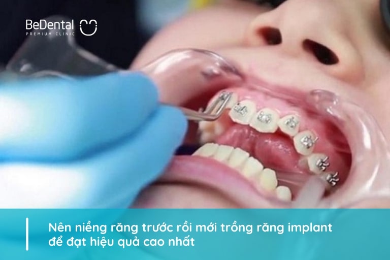 Nên niềng răng trước hay trồng răng implant trước?