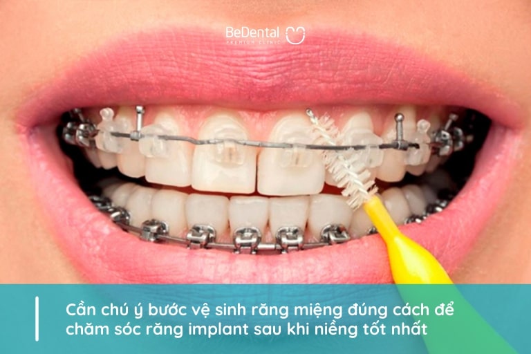 Cần chú trọng vệ sinh răng miệng đúng cách để chăm sóc răng implant sau khi niềng tốt nhất