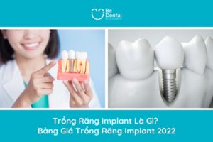 Trồng Răng Implant Là Gì? Bảng Giá Trồng Răng Implant 2022