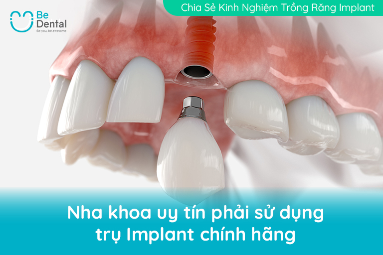 tru implant chinh hang